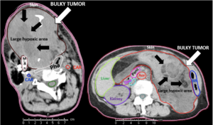 Beispiel für großvolumigen Tumor