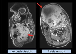 Beispiel PATHY: Plattenepithelkarzinom