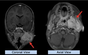 Example Pediatrics: Rhabdomyosarcoma