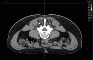 Animation: Treatment plan sarcoma